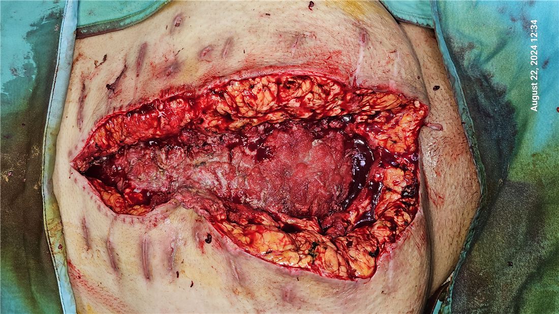 Open abdomen with massive soft tissue defect