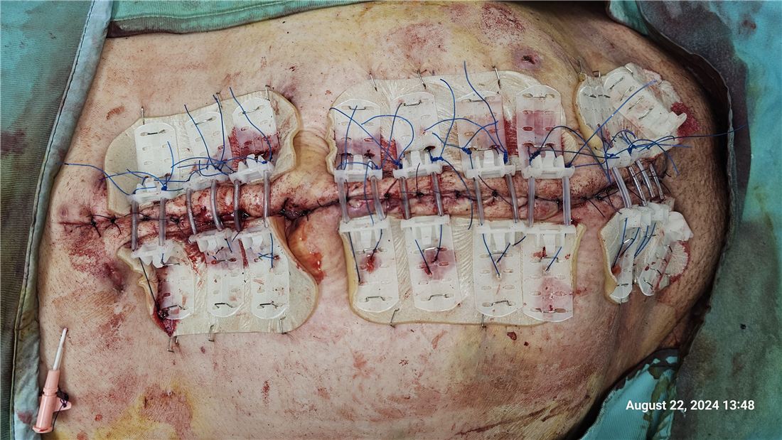 Early stabilization with TopClosure