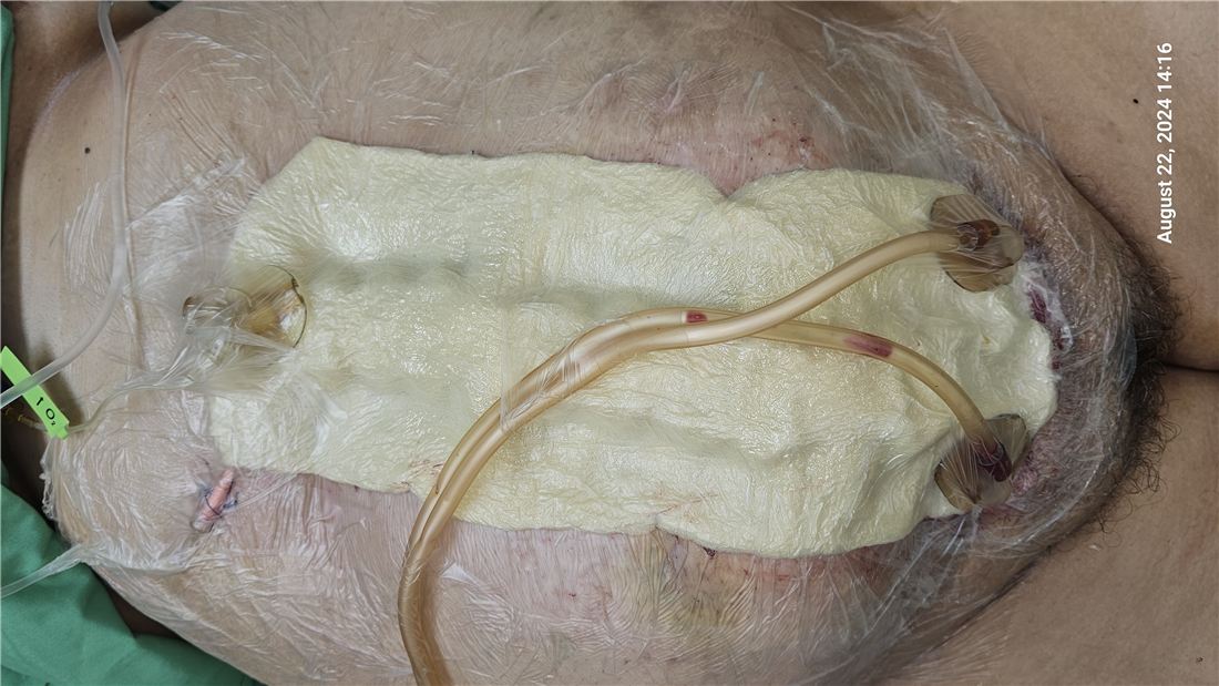 ROI-NPT dressing on the abdomen