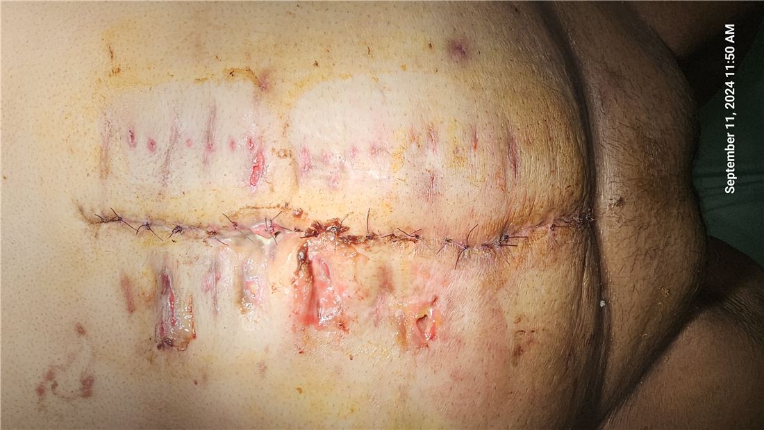 Healed abdominal wall