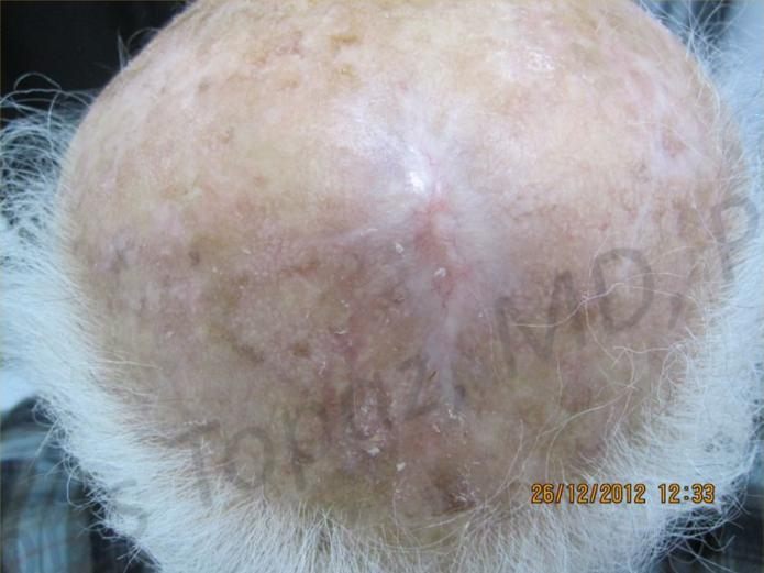 After treatment: healed