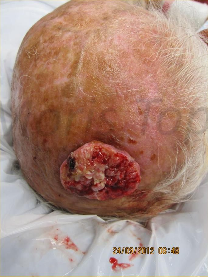 Before treatment: Large sarcoma resection, healed at 3 months