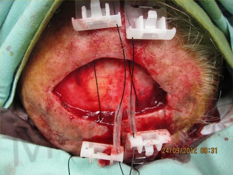 During treatment with TopClosure®