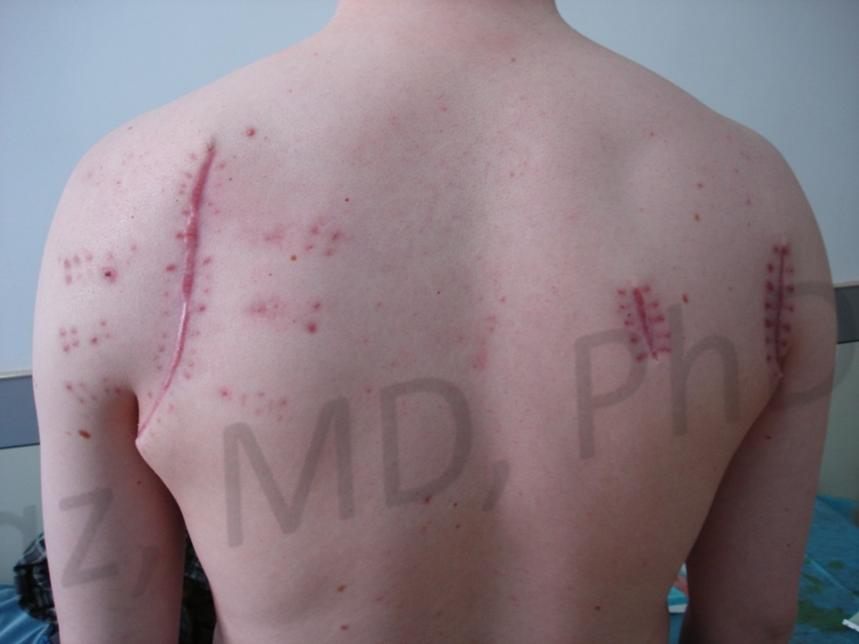 After treatment: healed
