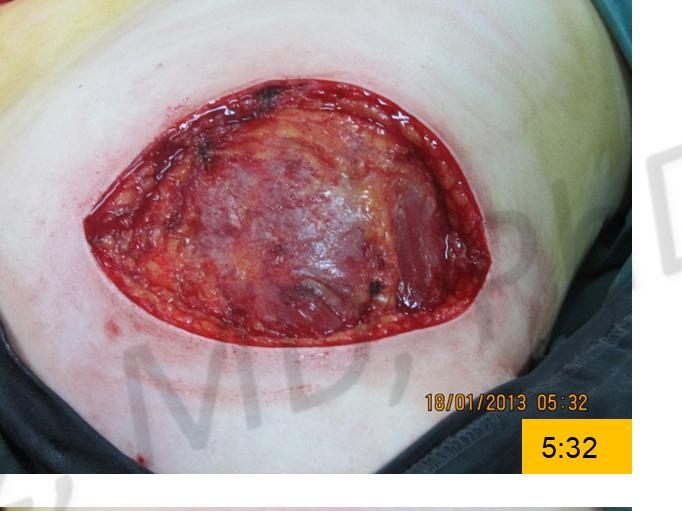 Before treatment: Wide excision of malignant melanoma (back)