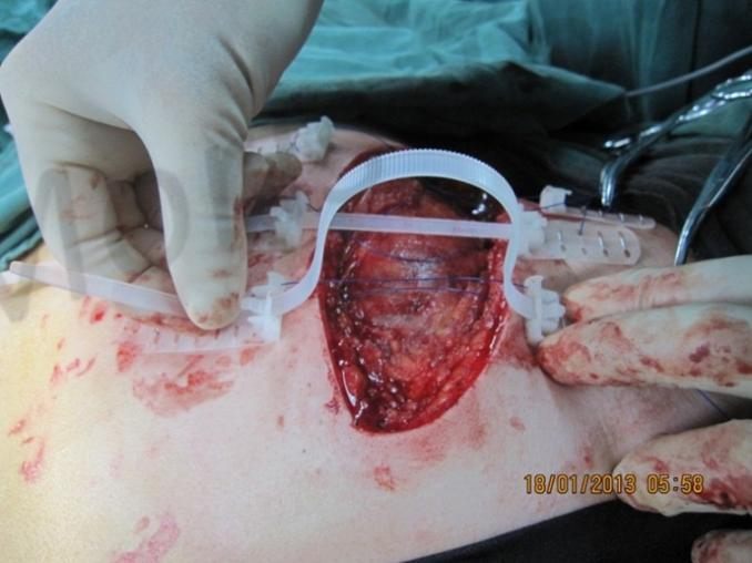 During treatment with TopClosure®