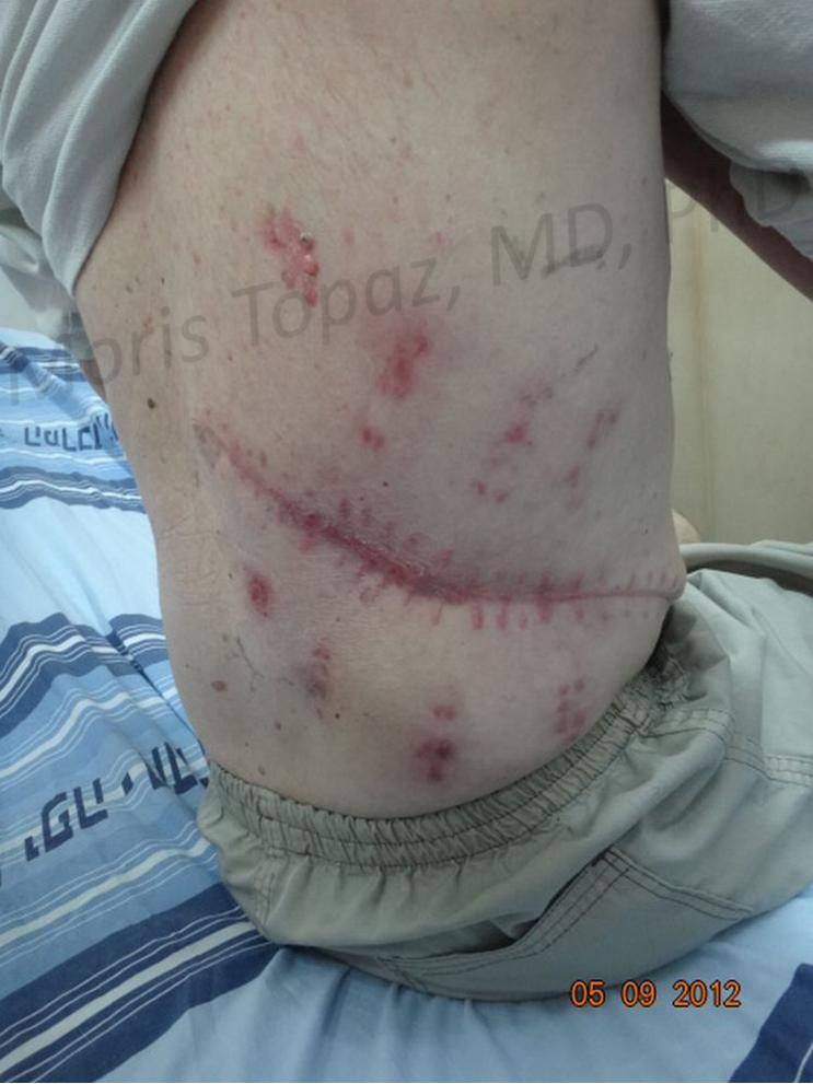 After treatment: healed
