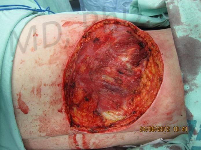 Before treatment: Giant defect, squamous cell carcinoma (flank)