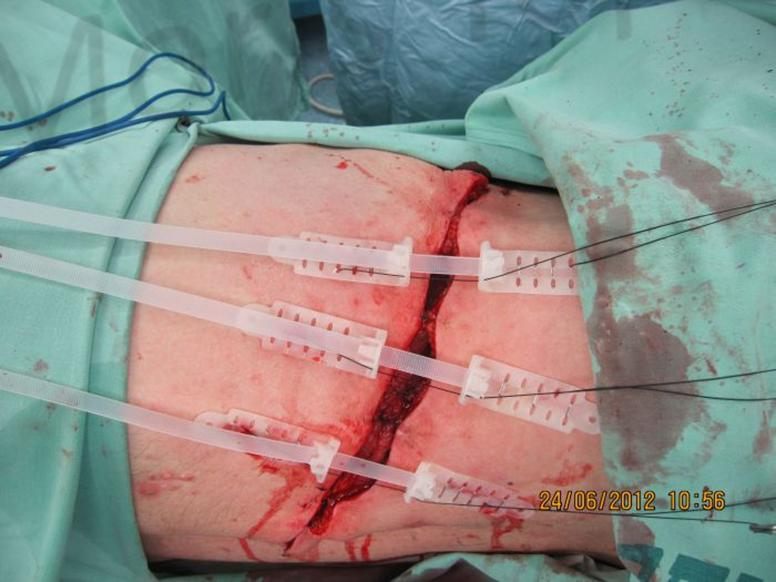 During treatment with TopClosure®