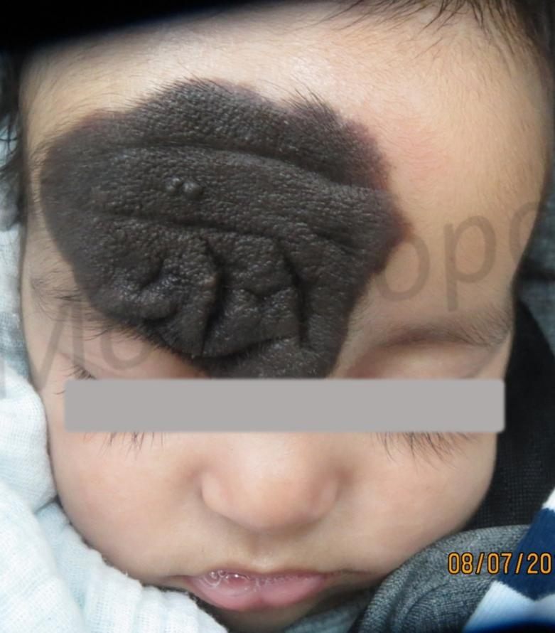 Before treatment: Large scalp defect, pediatric patient