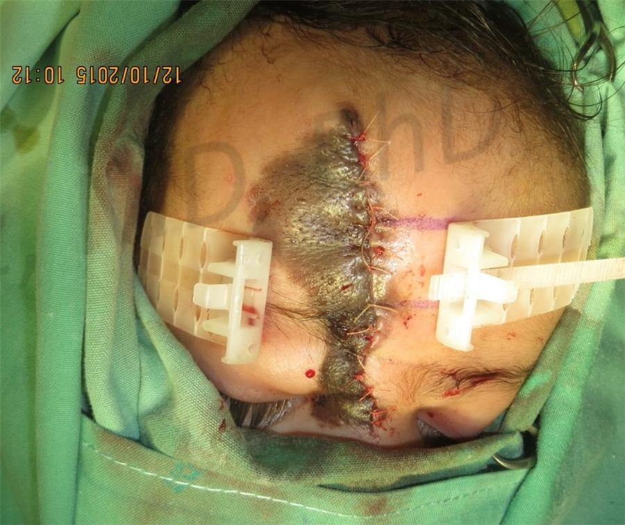 During treatment with TopClosure®