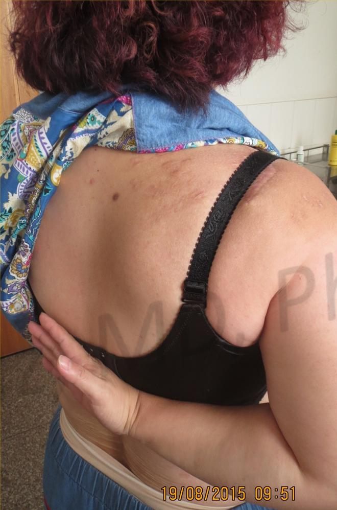 After treatment: healed