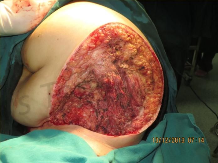 Before treatment: Giant shoulder defect, closed within 2 hours