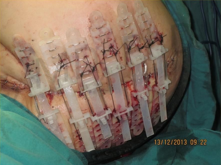 During treatment with TopClosure®