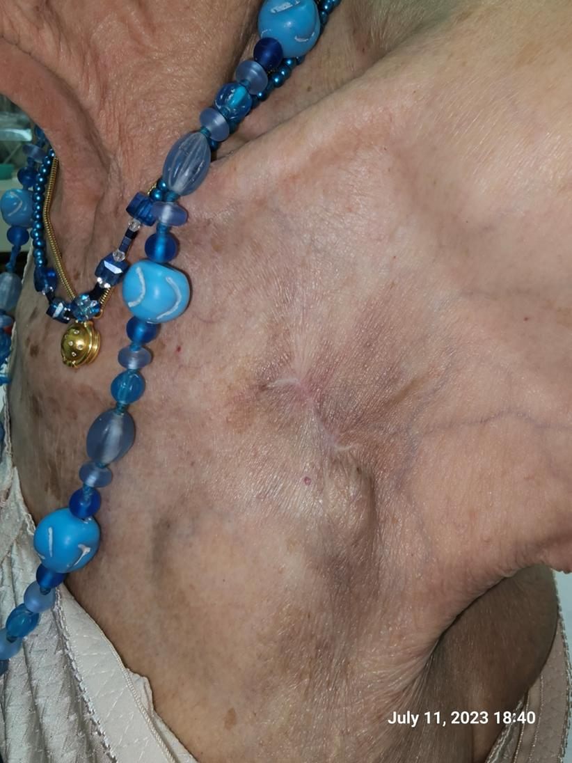 After treatment: healed