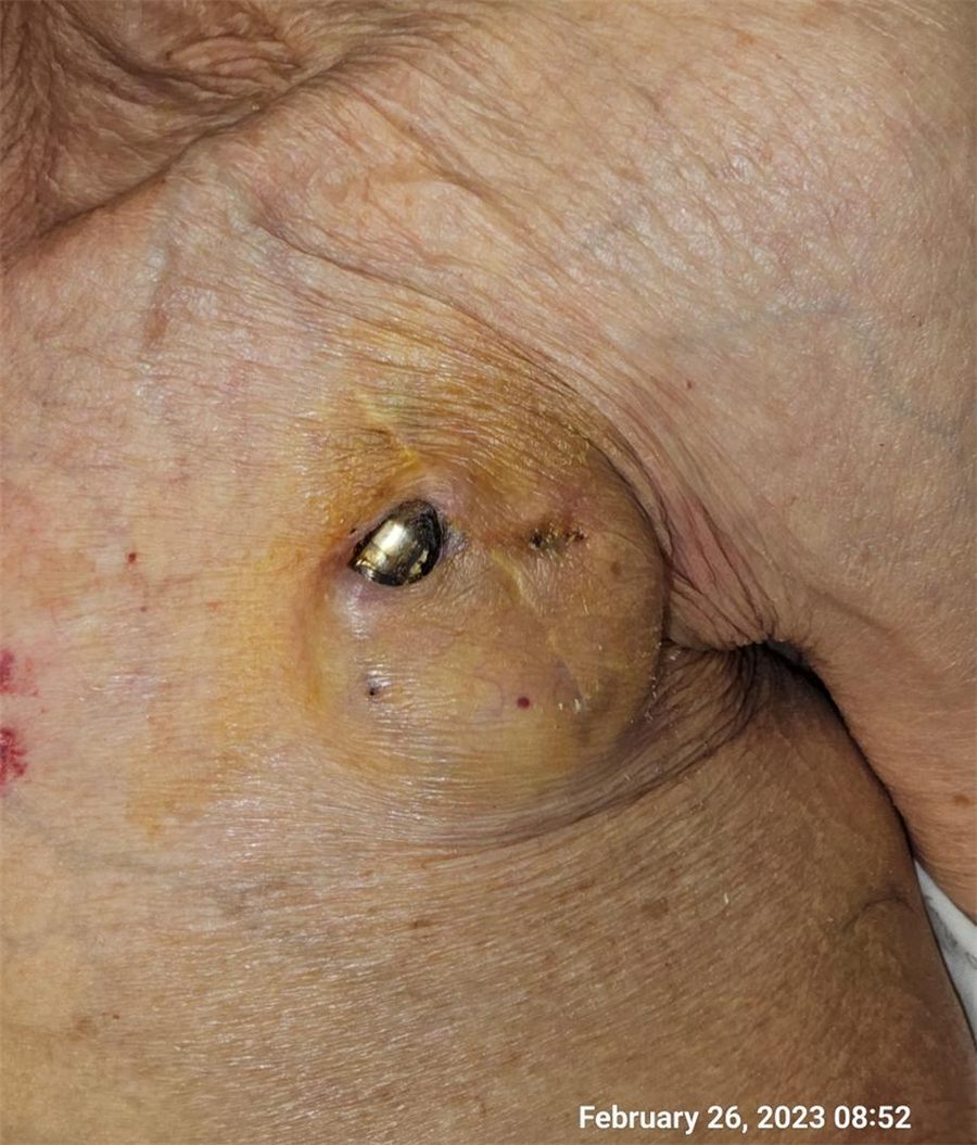 Before treatment: Infected pacemaker, closure at 3 weeks