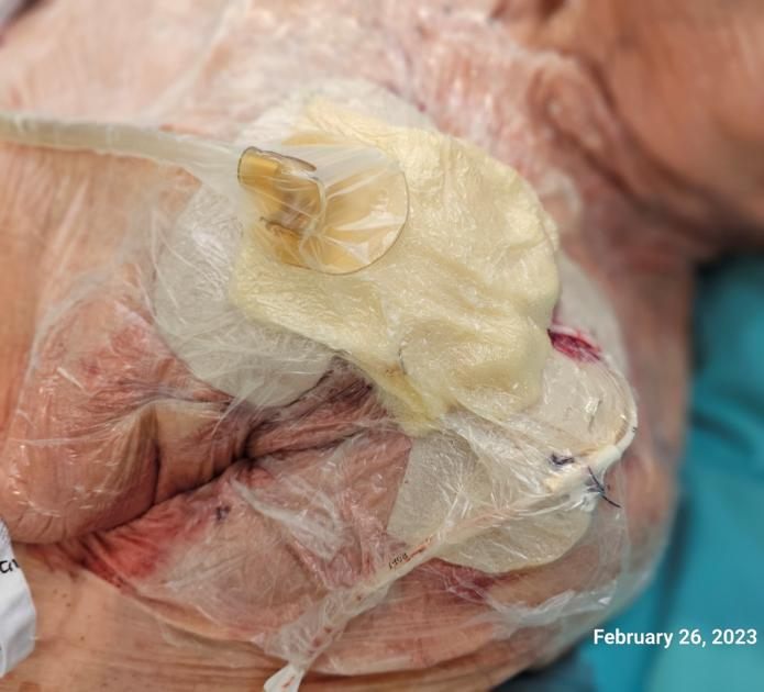 During treatment with MeCare α® NPT