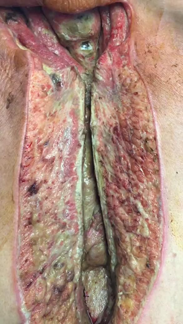 Before treatment: Deep sternal wound infection, closed and healed