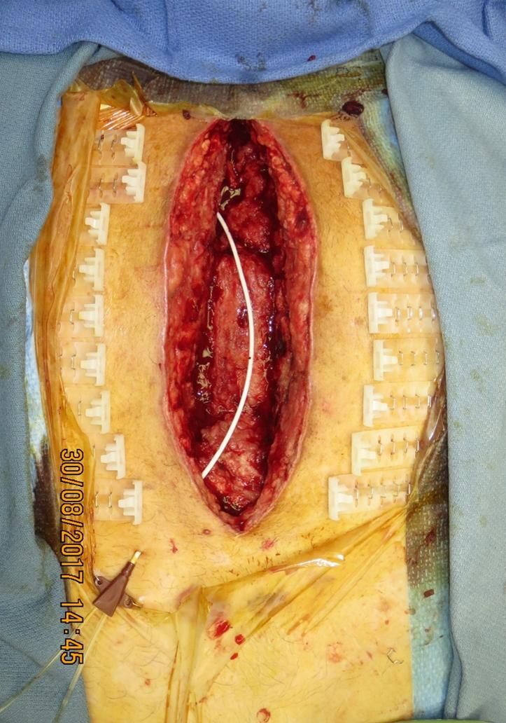 During treatment with Vcare α® NPT