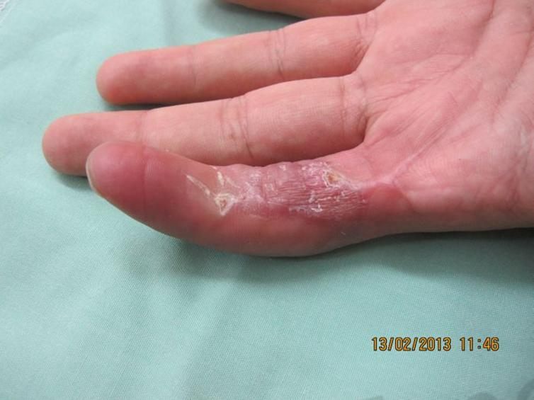 After treatment: healed