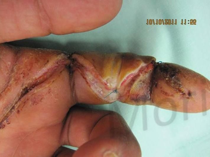 Before treatment: Hand trauma reconstruction