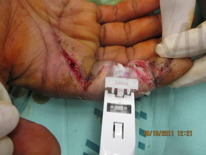 During treatment with TopClosure®