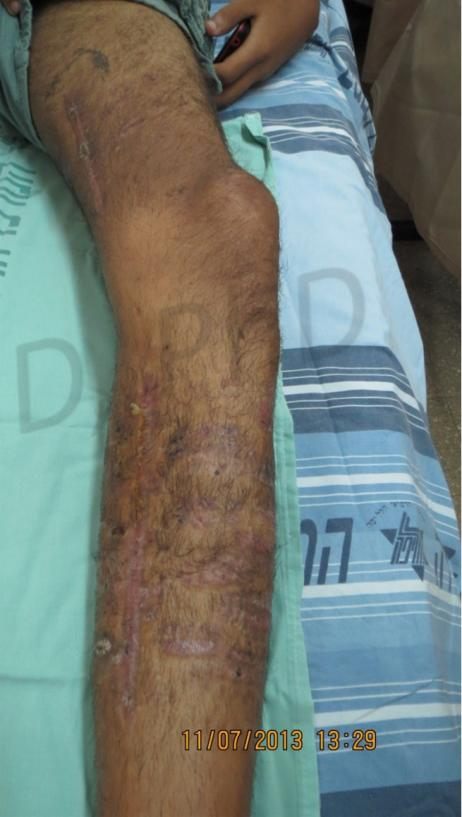 After treatment: healed