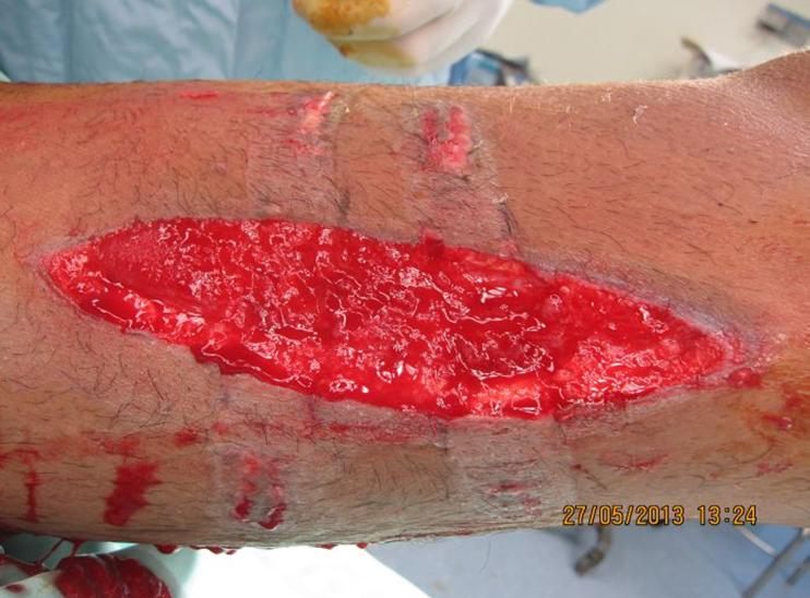 Before treatment: Severe leg wound