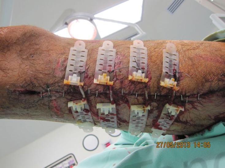During treatment with TopClosure®