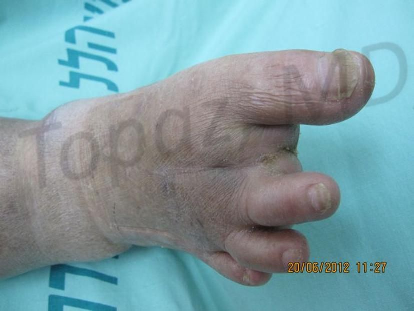 After treatment: healed
