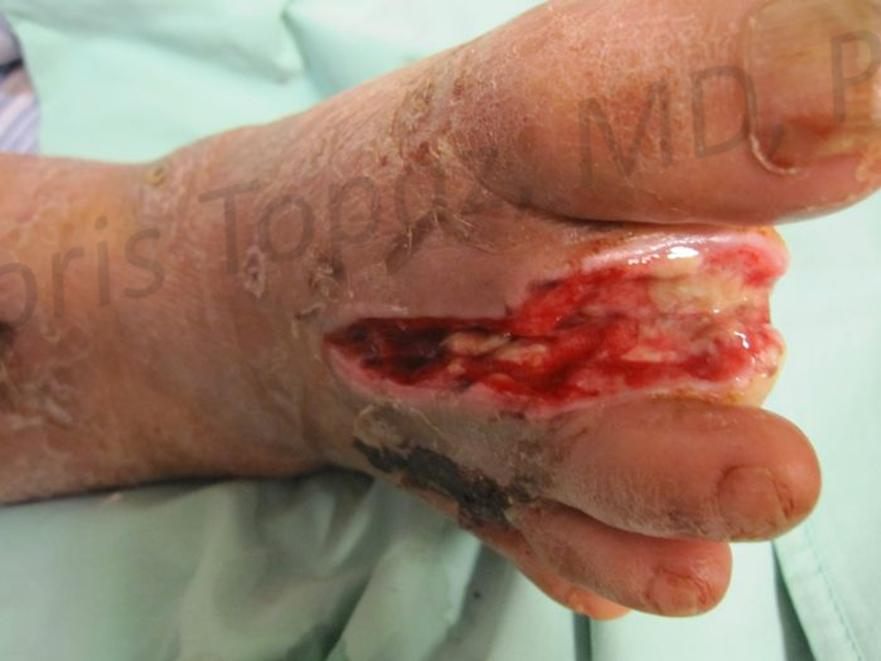Before treatment: Diabetic foot ulcer, healed