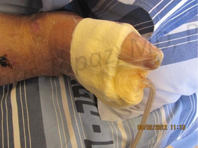 During treatment with NPT