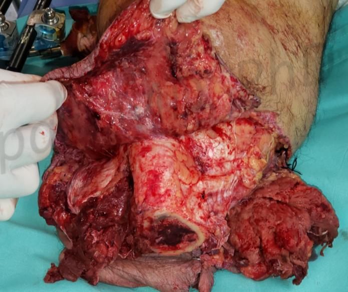 Before treatment: Crush-degloving forearm injury