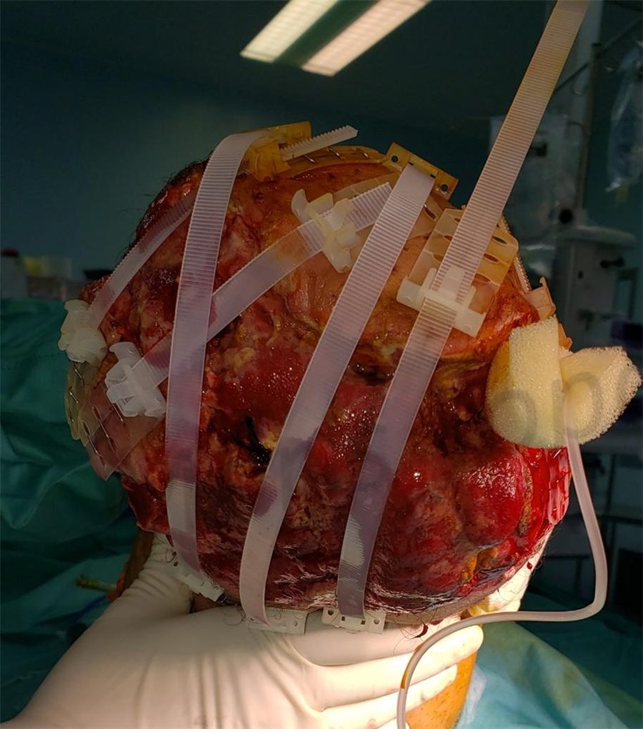During treatment with TopClosure®
