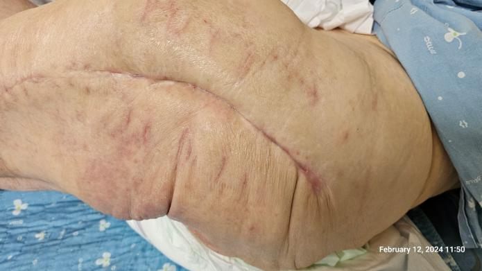 After treatment: healed