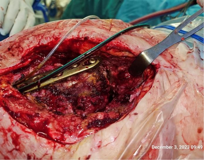 Before treatment: Bone infection, limb salvage at 2.5 months