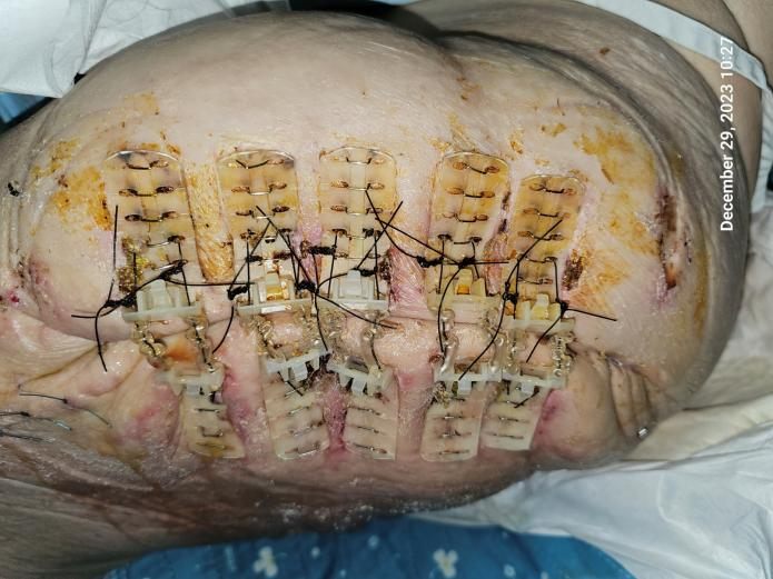 During treatment with TopClosure®