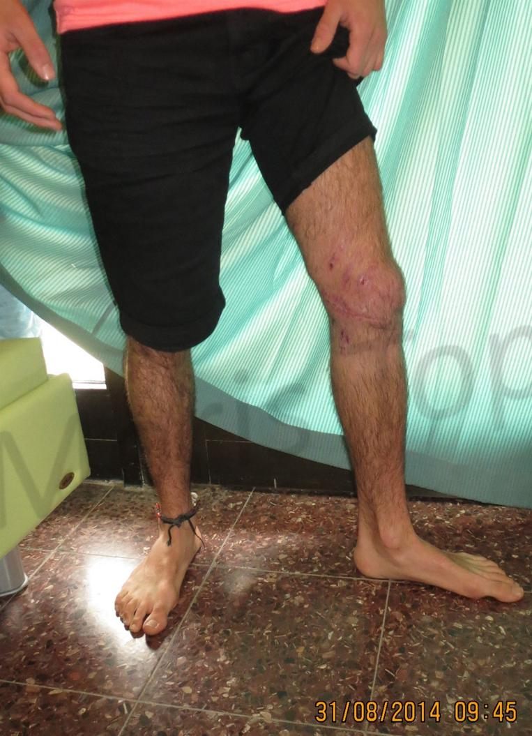 After treatment: healed