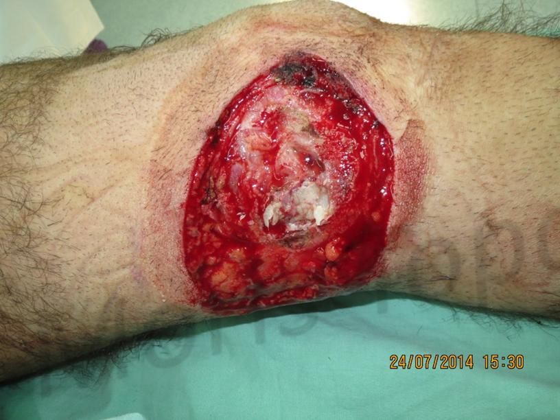Before treatment: Combat leg injury, healed at 8 weeks