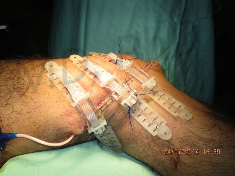 During treatment with TopClosure®