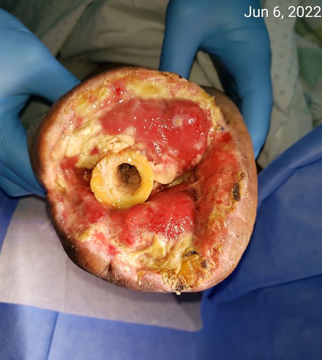 Infected diabetic foot at baseline
