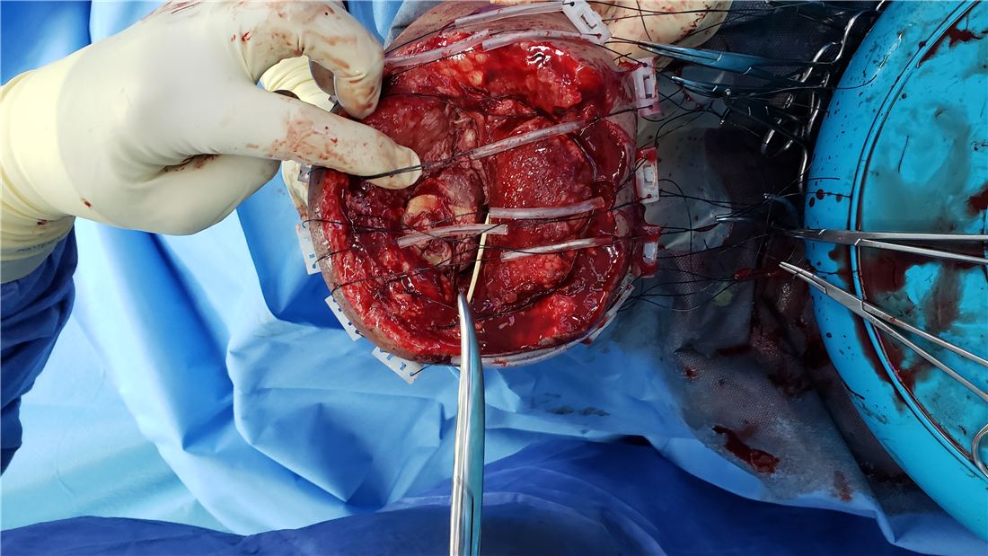 Surgical debridement