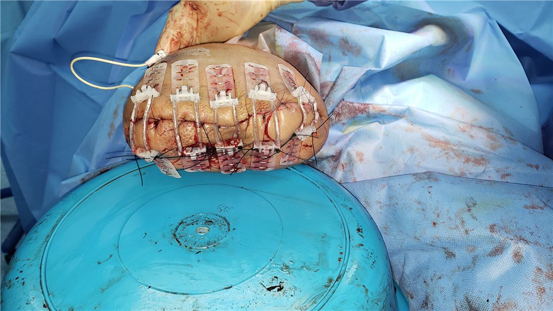 TopClosure stabilization of the foot