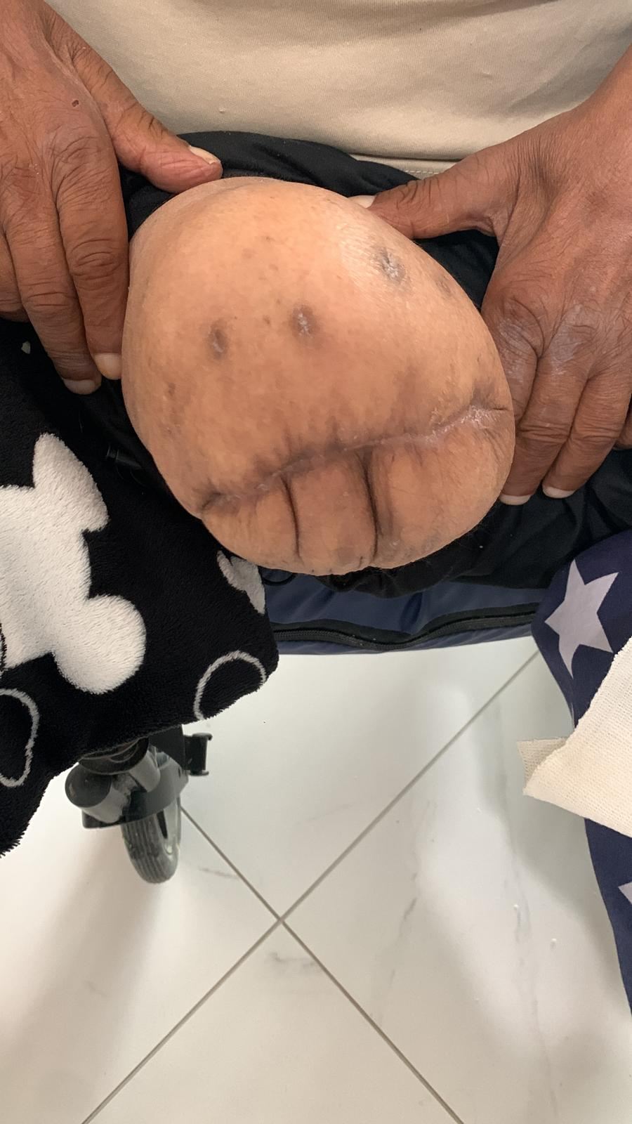 Healed foot, limb preserved