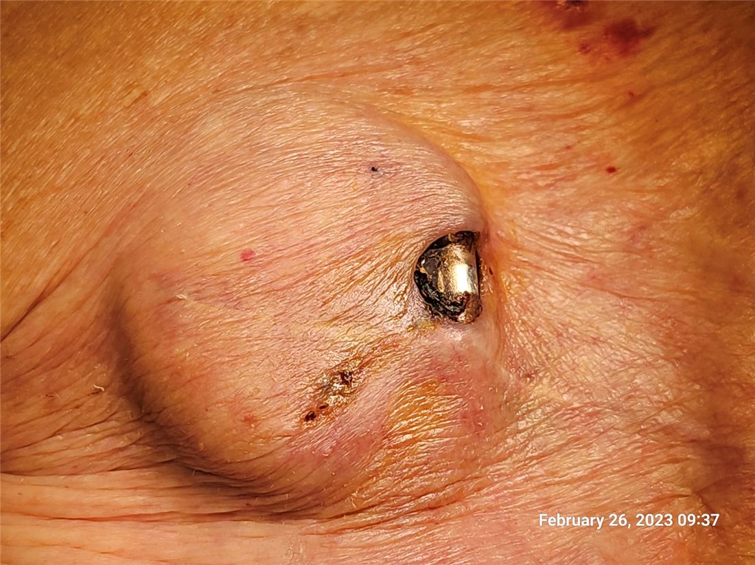 Infected wound with exposed implant