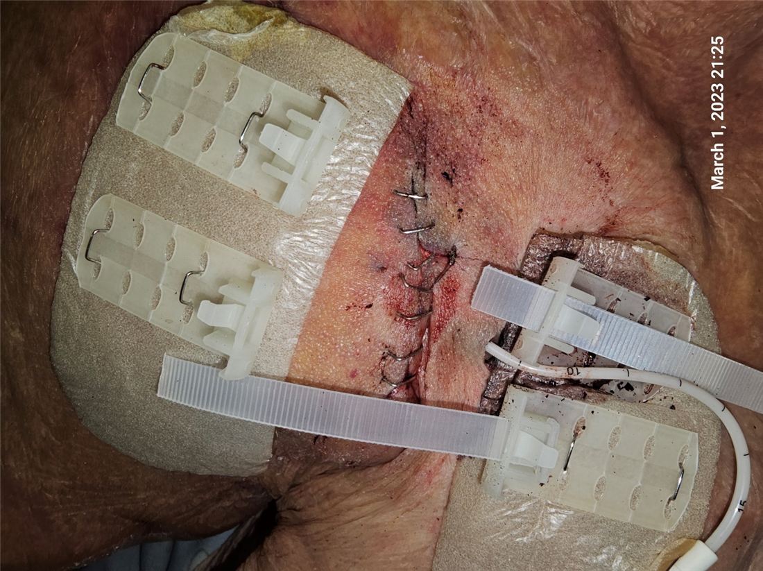 TopClosure stabilization