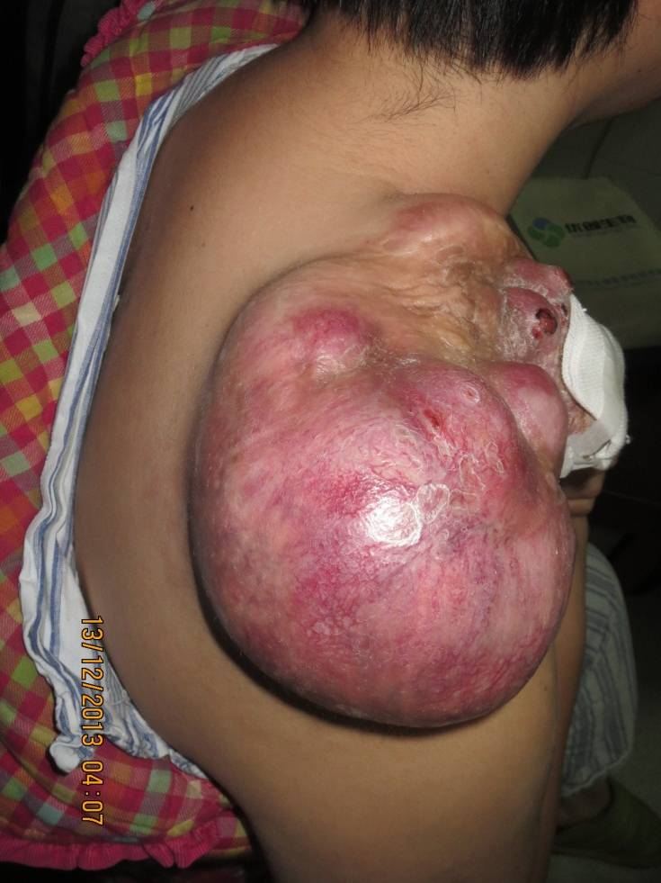 Giant tumor before excision