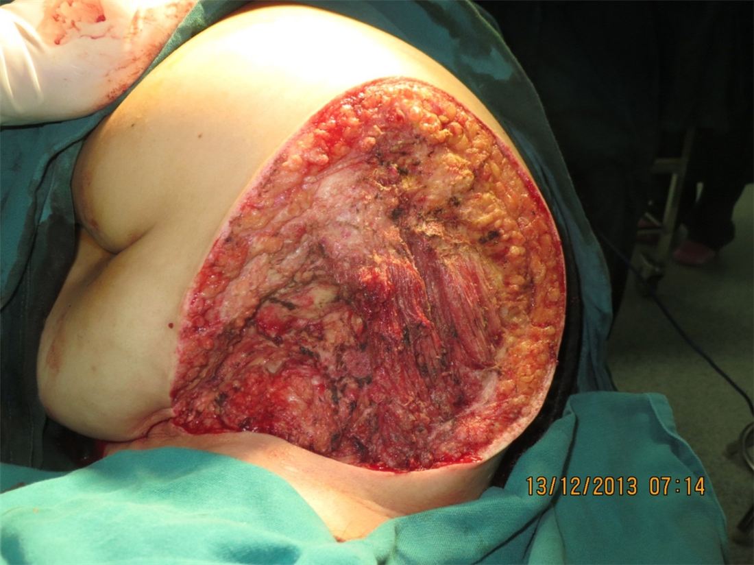 Large skin defect after tumor excision
