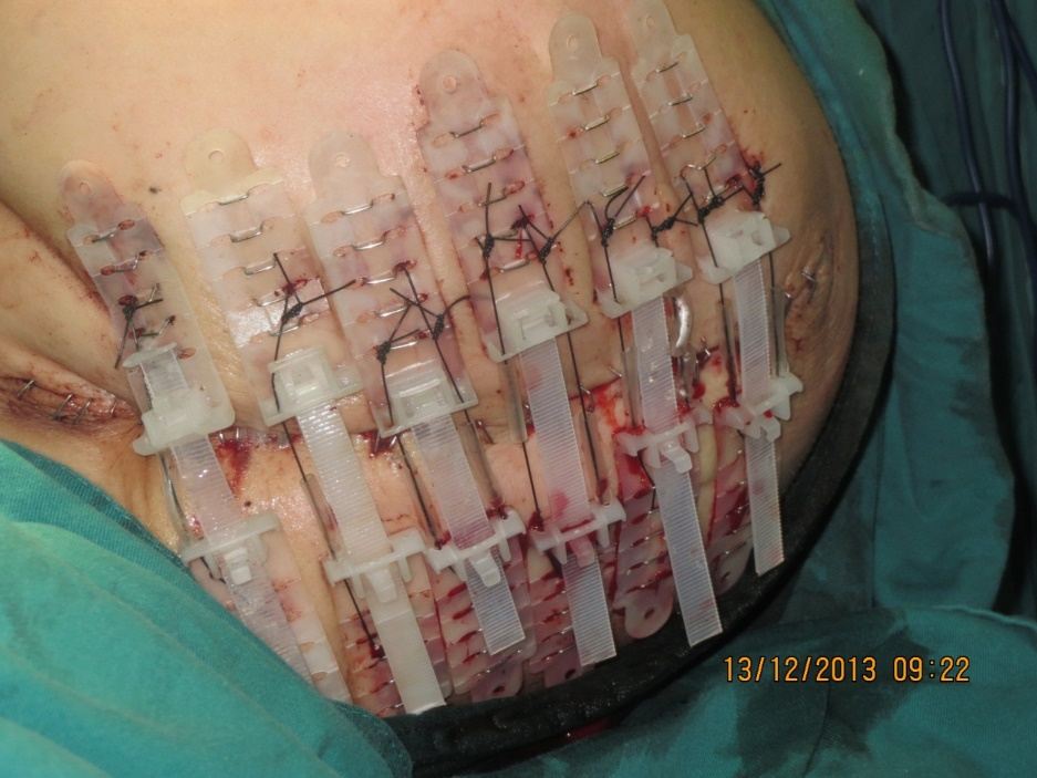 Primary closure using TopClosure, intraoperative