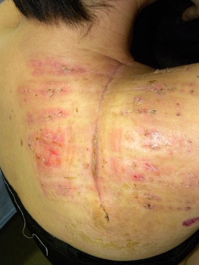 21 days post-operative